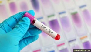 [2022] ESR Test क्या होता है? ईएसआर टेस्ट कैसे होता है?